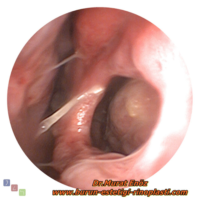 Septum perforasyonu tanımı - Septum perforasyonu  nedenleri - Septum perforasyonu belirtileri - Septum perforasyonu tedavisi - Açık teknik septum perforasyonu ameliyatı - Açık teknik septum perforasyonu onarımı - Burun duvarında delik