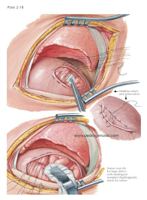 THORACIC APPROACH TO REPAIR OF DIAPHRAGMATIC HERNIA