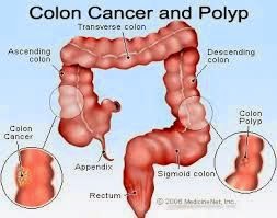 Colon Cancer: 2015