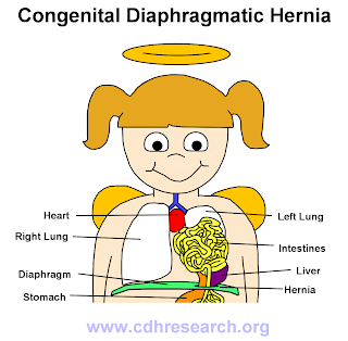 Congenital Diaphragmatic Hernia