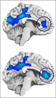 fMRI scans of cocaine-addicted individuals