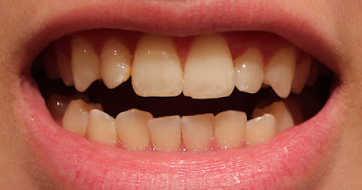 Răng bị ố vàng có nên tẩy trắng răng