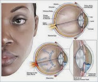 informasi tentang penyakit glaukoma