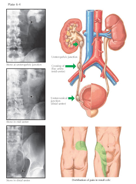 MAJOR SITES OF RENAL STONE IMPACTION