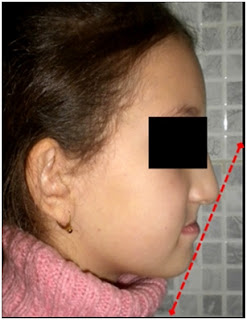 15. Vue latérale visualisant un profil concave chezune fillette de 10 ans