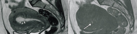 Chapitre 9 : Pathologies myometriales