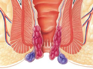 Penyakit Wasir Atau Ambeien Parah, Cara Mengobati Ambeien Atau Wasir Dengan Obat Herbal, mengobati penyakit Ambeien Dengan Jintan Hitam, Cara Alami Mengobati penyakit Wasir Secara Alami, Www.Obat Wasir, Cara Mengobati Ambeien Dgn Daun Sirsak, Obat untuk mengobati Wasir Tablet, Obat Ambeien Atau Wasir Dalam, Wasir Berdarah Sembuh, Obat Penyakit Ambeyen Ambeyen, Tips Mengobati penyakit Wasir Alami, Cara Mengobati Ambeien Keluar Darah, Mengobati Penyakit Ambeyen Habis Melahirkan, Obat Wasir Atau Ambeien Ambeyen Alami, Cara Mengobati Ambeien Atau Wasir Bagi Ibu Menyusui, Obat untuk penyakit Ambeien Adalah, Penyakit Ambeien Dan Cara Mengatasinya, Mengobati Wasir Atau Ambeien Dengan Madu, Obat Ambeyen Dari Buah Buahan, Mengatasi Wasir Dengan Daun Sirsak, Efek Obat Wasir, Obat untuk penyakit Wasir Ibu Hamil, Obat untuk penyakit Ambeien Yang Mujarab, Obat untuk mengobati Wasir Bagian Dalam, Tips Mengobati Ambeien Ambeien Atau Wasir, Gejala Penyakit Wasir Atau Ambeien, Cara Mengobati Ambeyen Tanpa Minum Obat, Obat Penyakit Ambeyen Dokter, Pengobatan Wasir Ibu Hamil, Cara Mengatasi penyakit Ambeien Saat Hamil 9 Bulan