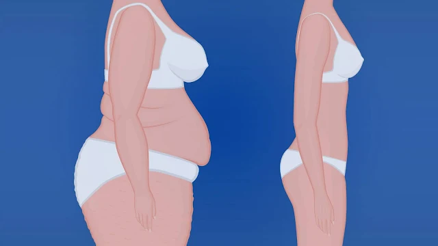 Pregnancy After Weight-Loss Surgery