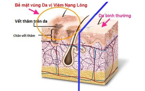 Viêm nang lông và cách chữa đơn giản tại nhà