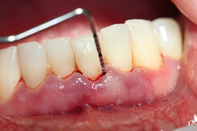Nguyên nhân gây viêm chân răng lâu ngày