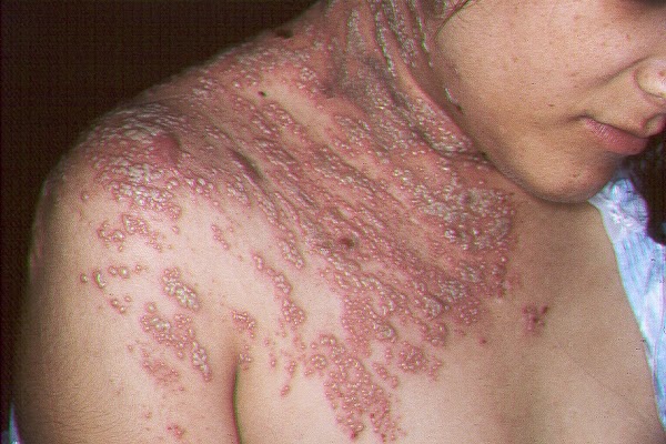 pengobatan herpes tradisional