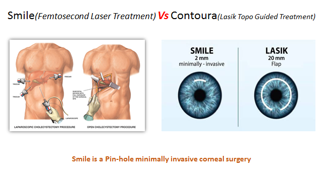 Smile vs contoura comparison