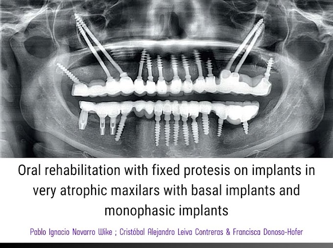 PDF: Oral rehabilitation with fixed protesis on implants in very atrophic maxilars with basal implants and monophasic implants