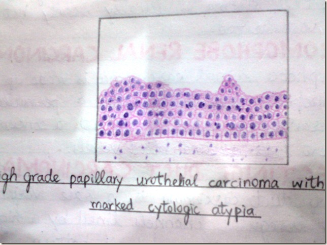 tcc- transitional(urothelial) carcinoma diagram histopathology