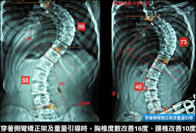 脊椎側彎矯正架, 脊椎側彎惡化, 脊椎側彎矯正, 脊椎側彎 物理治療, 脊椎側彎復健, 脊椎側彎治療