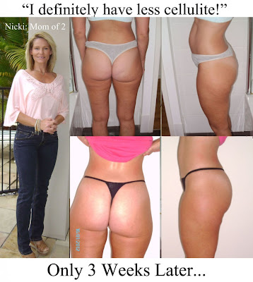 Kick-butt Cellulite Redux Program eBook review, Reports by Rakuyaz 
