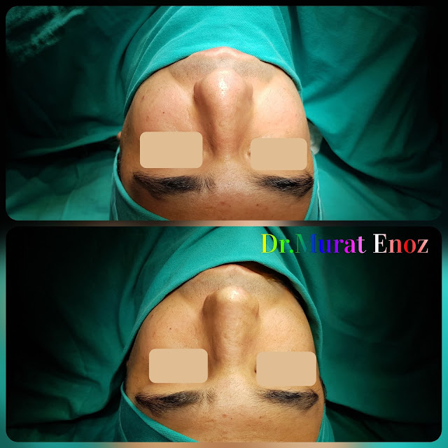 Thick Skinned Male Rhinoplasty Turkey, Nose Job For Men Istanbul, Droopy Nose Aesthetic For Men
