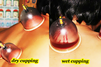 Wet Cupping for Diabetes - What Is The Difference Dry and Wet Cupping