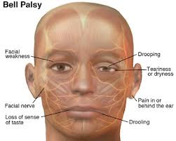 BELL'S PALSY