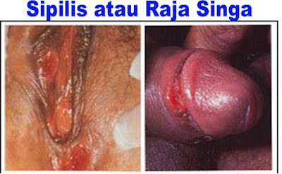 Sifilis Atau Raja Singa