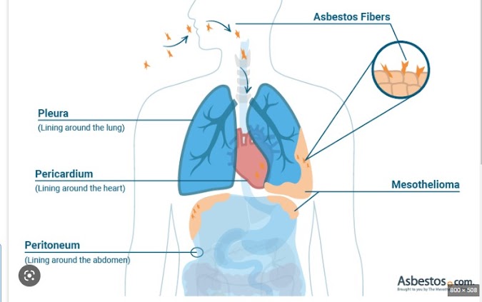  Pleura Disease and Mesothelioma