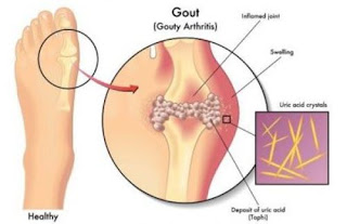 Efek Asam Urat Berlebihan, Pengukur Gula Darah Kolesterol Dan Asam Urat, Tanaman Obat Penyakit Asam Urat, Asam Urat Dn Kolesterol, Asam Urat Normal Untuk Lansia, Asam Urat Karena Ginjal, Obat Tradisional Penyakit Asam Urat Dan Rematik, Asam Urat Telapak Kaki Panas, Cara Mengobati Penyakit Asam Urat, Ramuan Untuk Asam Urat Herbal, Asam Urat Kolesterol Gula Darah, Cara Cepat Menghilangkan Rasa Sakit Asam Urat, Mengobati Asam Urat Akut, Efek Asam Urat Pada Ginjal, Buah Sebagai Obat Asam Urat, Cara Mengatasi Asam Urat Berlebih, Asam Urat Karena, Obat Asam Urat Yg Dijual Di Apotik, Samakah Asam Urat Dan Rematik, Obat Alami Tuk Asam Urat, Cara Alami Turunkan Kolesterol Dan Asam Urat, Manfaat Es Batu Untuk Asam Urat, Sakit Asam Urat Boleh Dipijat, Obat Tradisional Untuk Penyakit Rematik Dan Asam Urat, Kadar Asam Urat Normal Yaitu, Asam Urat Makan Jagung, Asam Urat Lumpuh, Cara Menyembuhkan Asam Urat Dengan Alami, Obat Alami Penyembuh Asam Urat, Tanda2 Asam Urat Dan Pencegahannya 