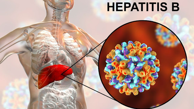 Pengobatan Hepatitis B dengan Herbal