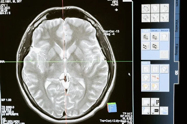 El COVID-19 causa anomalías cerebrales hasta 6 meses después de la infección