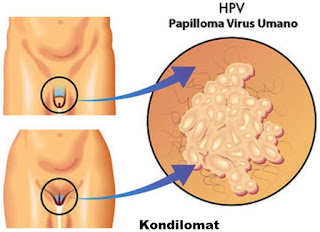 Obat Tradisional Untuk Kutil Kelamin Luar, Mengobati Kutil Kemaluan Dengan Bawang Putih, Kutil Kelamin Atau Kutil Di Kemaluan Pada Saat Hamil, Ramuan Tradisional Untuk Menghilangkan Kutil Kelamin Atau Kutil Di Kemaluan, Tips Mengobati Kutil Kelamin Atau Kutil Di Kemaluan, Bahaya Kutil Kemaluan Pada Ibu Hamil, Cuka Obat Kutil Kelamin Atau Kutil Di Kemaluan, Kutil Di Pangkal Zakar, Nama Obat Kutil Kelamin, Mengobati Kutil Kemaluan Dengan Kapur Sirih