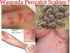 Obat Scabies Terbukti 7 Hari Sembuh