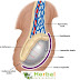 Hydrocele definition,  Hydrocele Causes, Hydrocele Symptoms & Hydrocele Treatment 