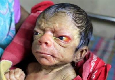 Baby With Benjamin button Disease