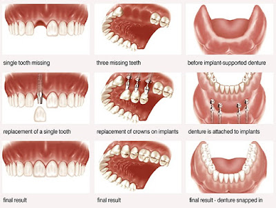 Tư vấn trông răng khi bị mất răng