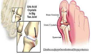 pengobatan asam urat secara tradisional, bahaya asam urat, pengobatan asam urat dan rematik, mengobati asam urat, penyebab asam urat, pengobatan asam urat tradisional, gejala asam urat, pengobatan asam urat secara medis, pantangan yang harus dihindari penderita asam urat, ramuan obat asam urat, efek asam urat, resiko asam urat