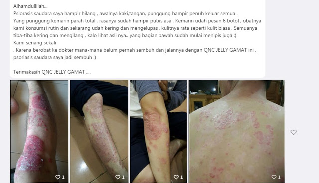 Obat Kanker Kulit Paling Ampuh