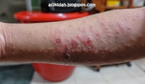 Eczema : di bahagian tangan sudah mula menjadi luka kerana digaru.