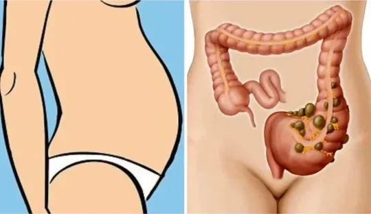 Barriga Inchada é Sintoma de qual Doença?