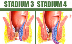 Obat Herbal Sembuhkan Wasir Stadium 3 dan Stadium 4