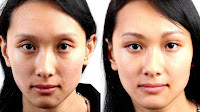 Brow Lift Surgery Cost