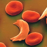 Sickle cells