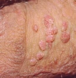 Artikel Pengobatan Virus Hpv