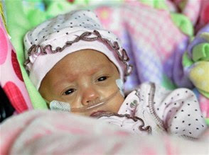 Melinda Star Guido la tercera bebe más pequeña del mundo en sobrevivir abandonó el hospital Melinda Star Guido la tercera bebe más pequeña del mundo en sobrevivir abandonó el hospital