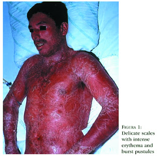 Pustulosa Acute Generalized Psoriasis (Von Zumbusch)