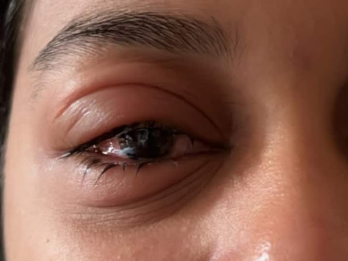 ملک بھر میں آشوب چشم کی وبا پھیلی ہوئی ہے ، کیا ہے اسکی علامات اور کیسے بچا جائے 