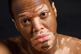 Acral or Acrofacial Vitiligo