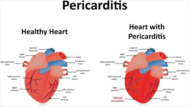 Pericarditis