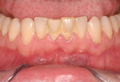 Cạo vôi răng dưới nướu bảo vệ răng toàn diện