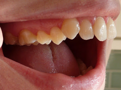 A side photo of crooked teeth before orthodontic treatment