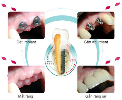 Phương pháp cấy ghép implant thay thế nhiều răng