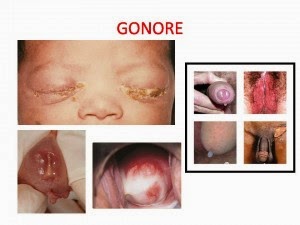 obat gonore aman untuk ibu hamil, obat gonore alami untuk ibu hamil, Obat Gonore Herbalis International